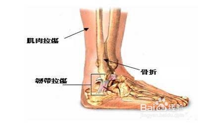 脚踝扭伤怎么办？