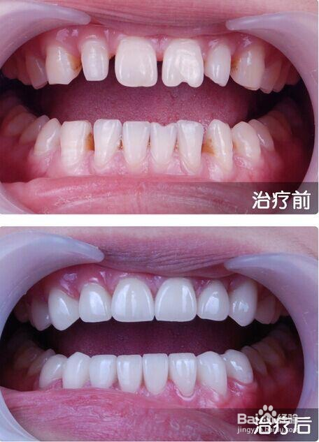 有牙缝怎样修复