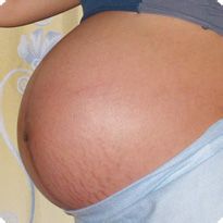 兰雅祛纹精油的使用方法