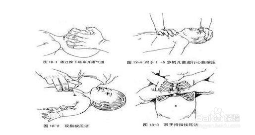 幼儿食物倒流处理方法