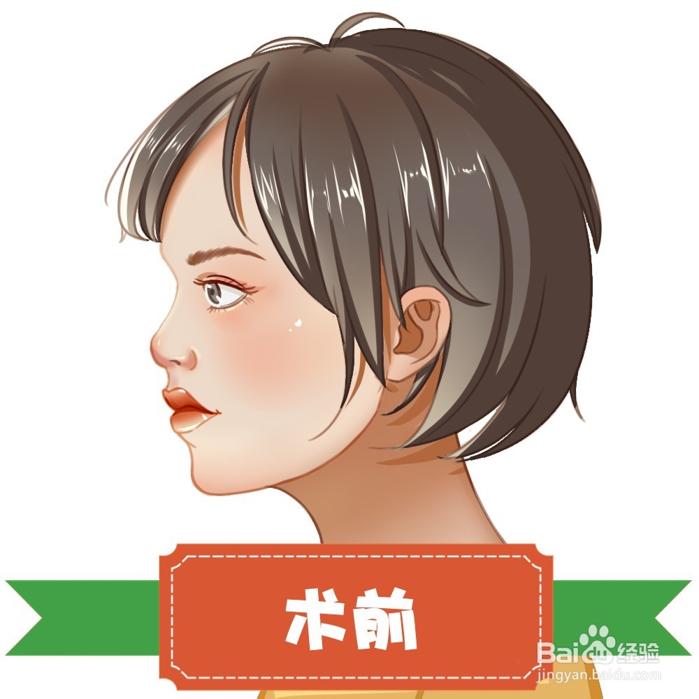 隆鼻手术过程