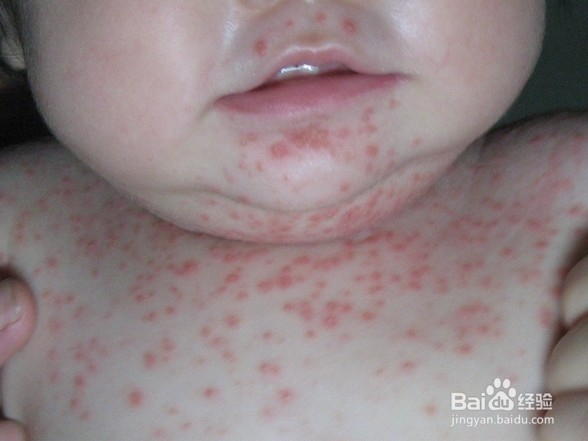 婴幼儿发烧症状不可小觑