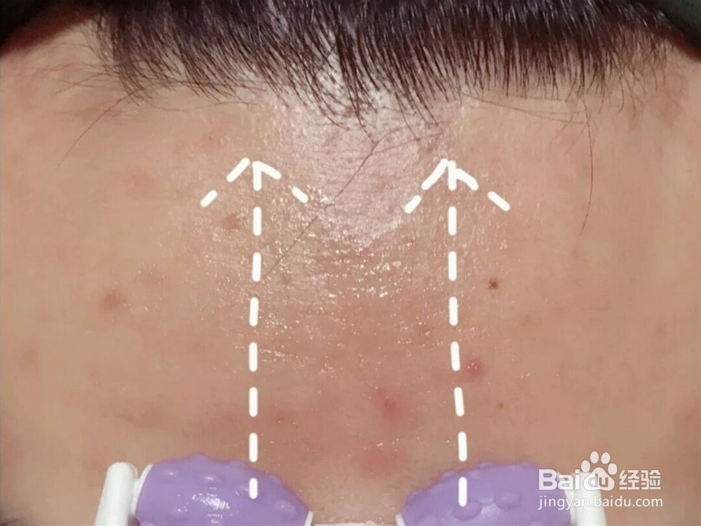 怎样去抬头纹