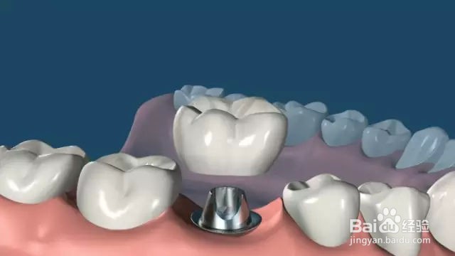 合肥种牙多少钱