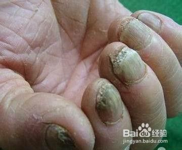 灰指甲图片初期症状，怎么确定是不是灰指甲