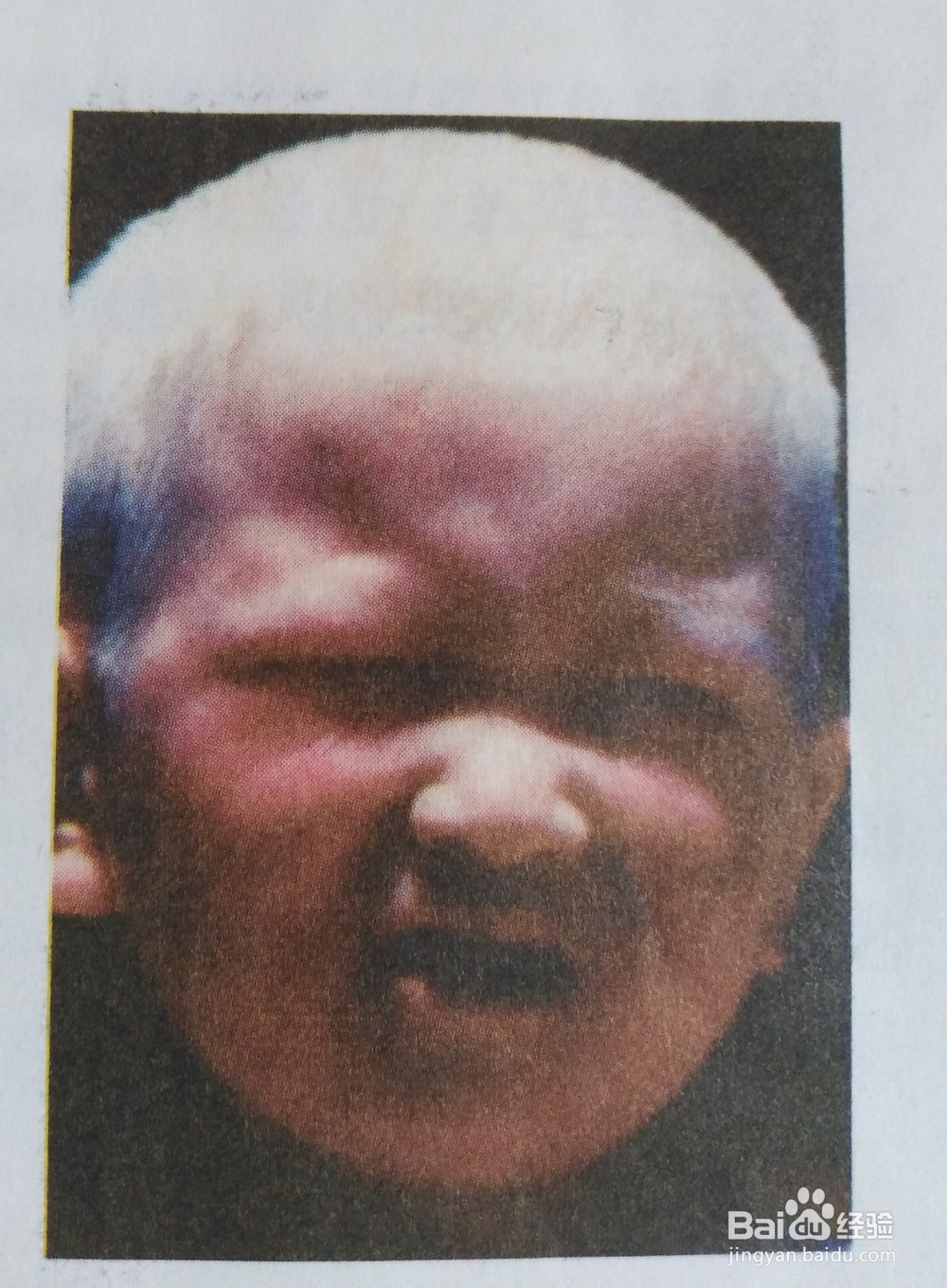 救人一命胜造七级浮屠——您了解苯丙酮尿症吗？