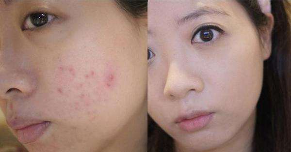 冒白尖的痘痘可以挤吗