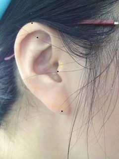 嗓子疼如何应用中医疗法