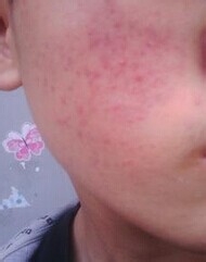 患了痤疮应该注意什么问题