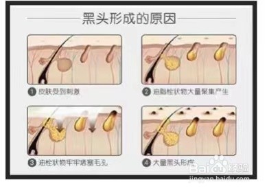 如何正确去黑头