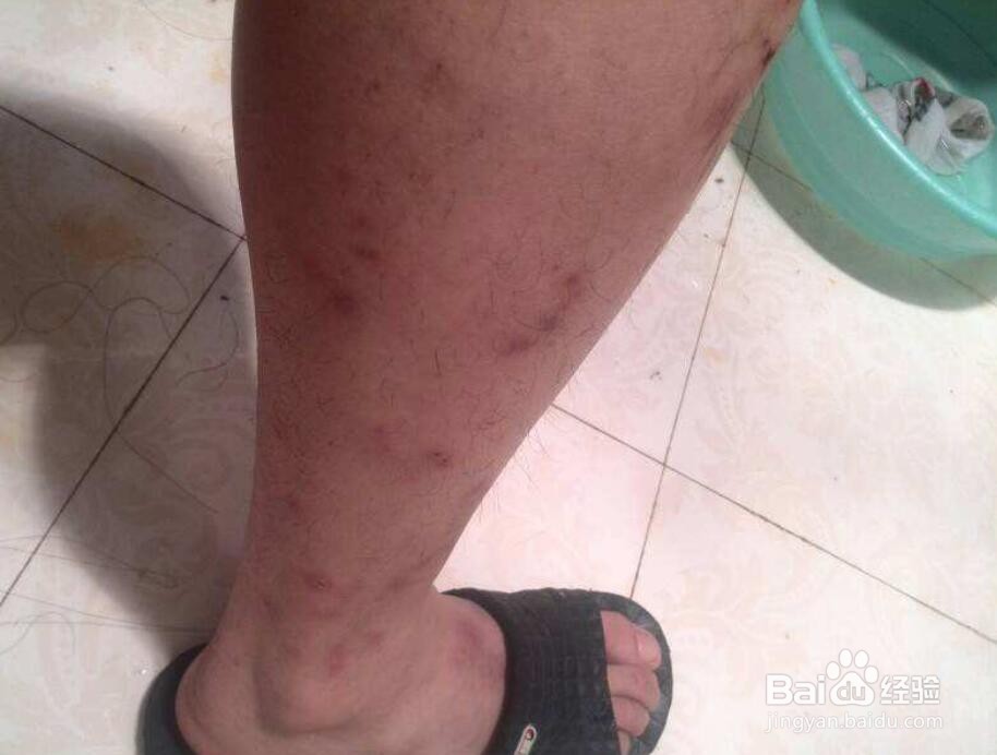 什么情况可以用伊之魅乳膏?