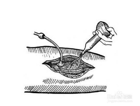 伤口为什么会化脓