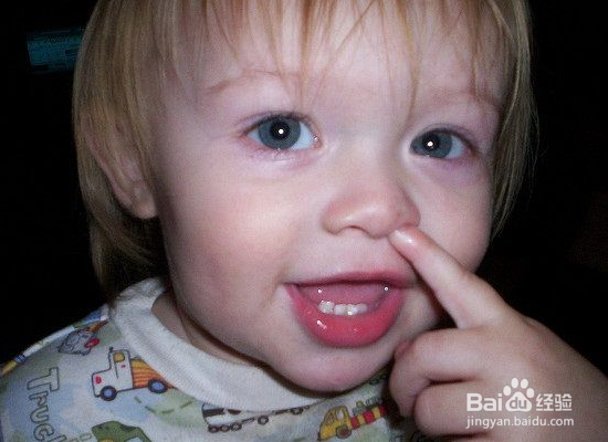 鼻出血怎么办?什么原因引起鼻出血?