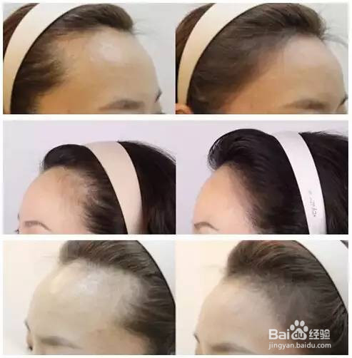 小脸神器发际线是这样做出来的