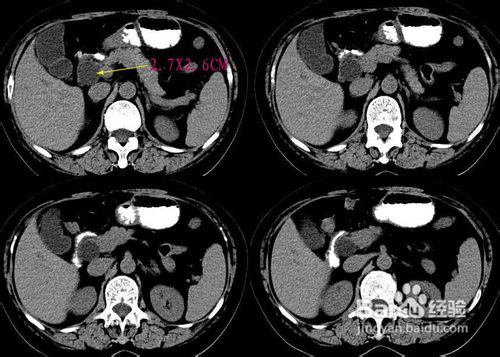 葡萄胎的治疗方式