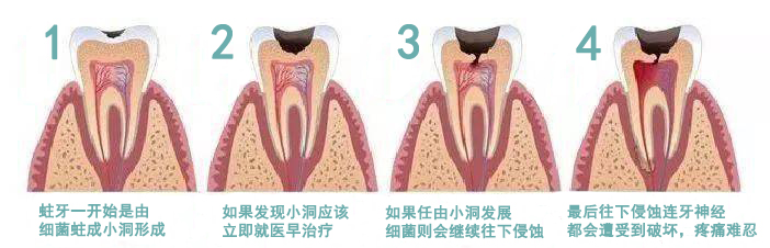 根管治疗是什么