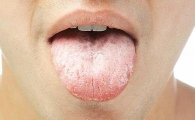 舌苔厚白是怎么回事?