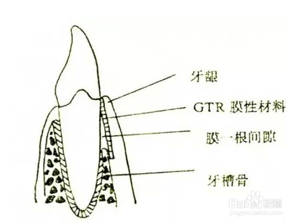 种植牙手术是如何操作的？
