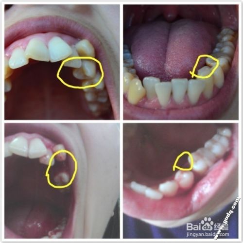 牙齿矫正：[7]带牙套多少钱？我的整牙价格