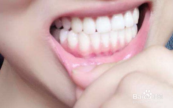 扁平苔藓症状哪些较常见