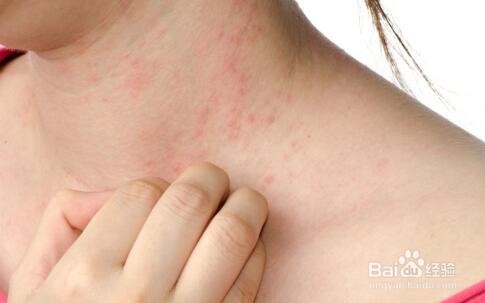 怎么治疗湿疹比较有效