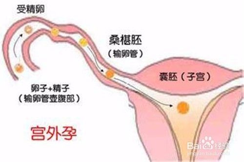 宫外孕早期症状有哪些宫外孕前兆 百度经验