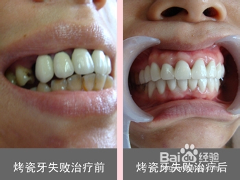 贵金属烤瓷牙优势是什么