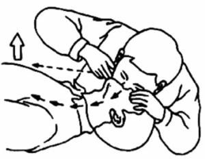 气道完全梗塞急救法