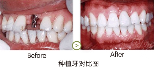 必須瞭解種植牙有什麼過程