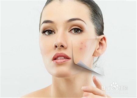 长痘痘的原因及调理方法