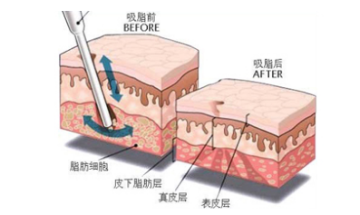 脸部减肥最有效方法