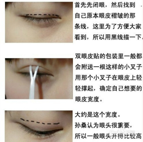 孙桑桑的双眼皮倒贴法