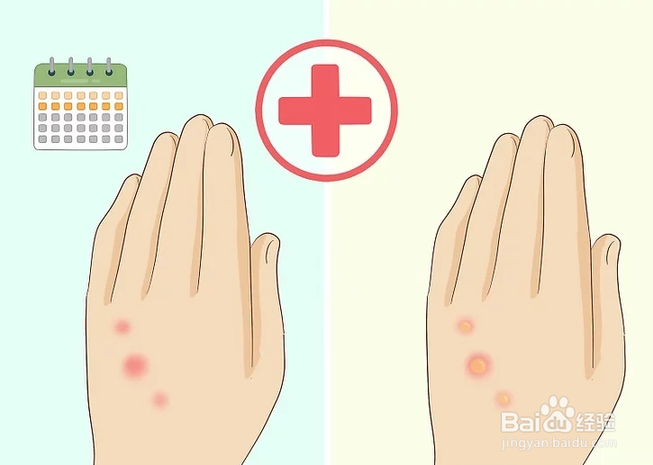 如何治疗床虫咬伤