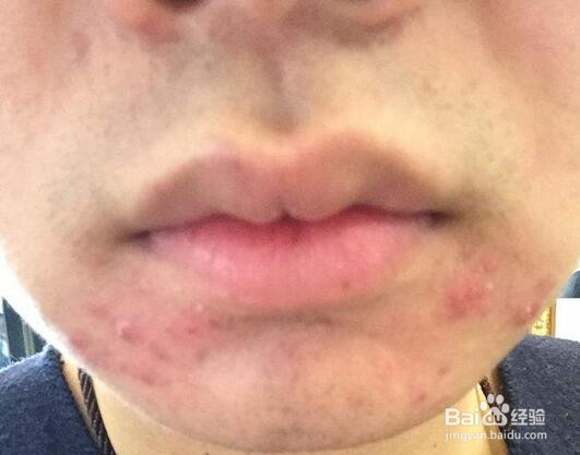 擦口红嘴唇起皮怎么办