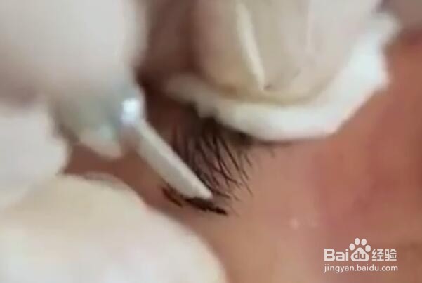 纹绣中途出血的预防及处理方法