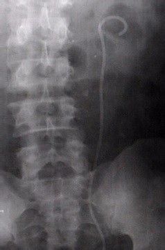 如何认识“肾结石”