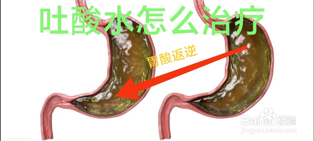 吐酸水怎么治疗