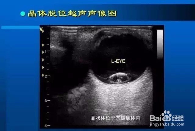 几种常见眼病B超图谱及诊断