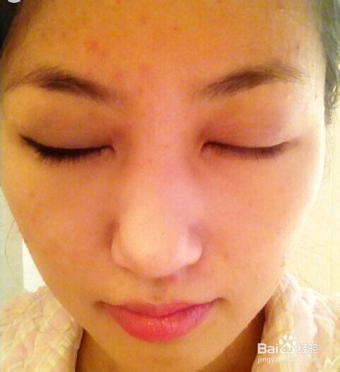 教你如何预防痘痘的生长