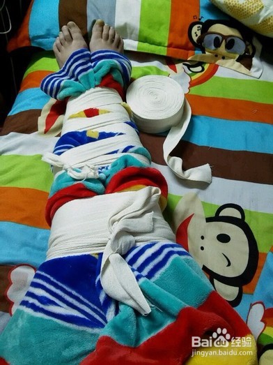 怎么矫正O型腿?