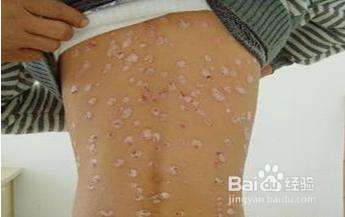 健康/养生 > 保健养生      体股癣是对体癣和股癣的总称,因此体股癣