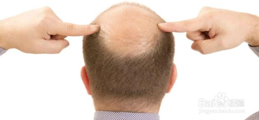男士头发掉得很严重,应该怎么办