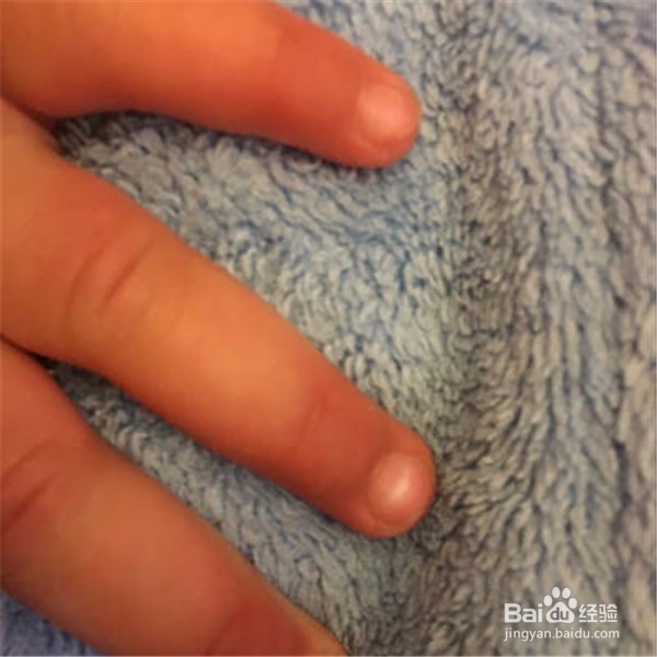 指甲上长白色的斑是怎么一回事?