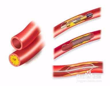 血管堵, 疾病生! 疏通血管就用这5招