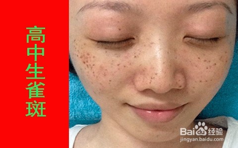 高中生怎样去斑/ 学生长什么斑/适合的祛斑方法