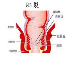 肛裂如何自愈