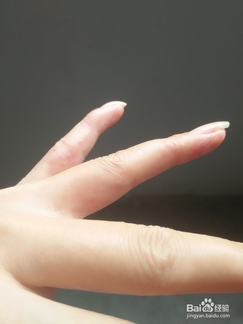 分享手上长水泡如何治愈的方法