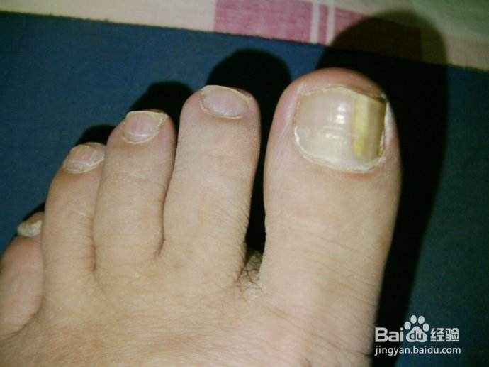 教你怎么治灰指甲