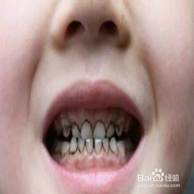 预防宝宝蛀牙的注意事项