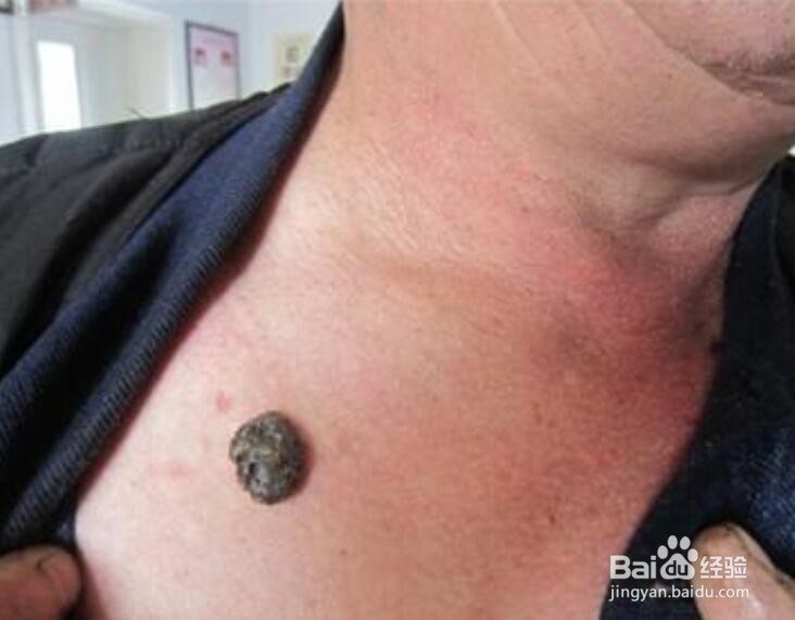 为什么痦子不能随便去掉？有什么危险？